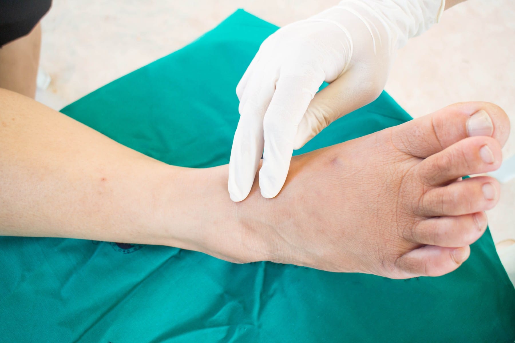 a doctor checking on a diabetic person's foot who may have charcot foot