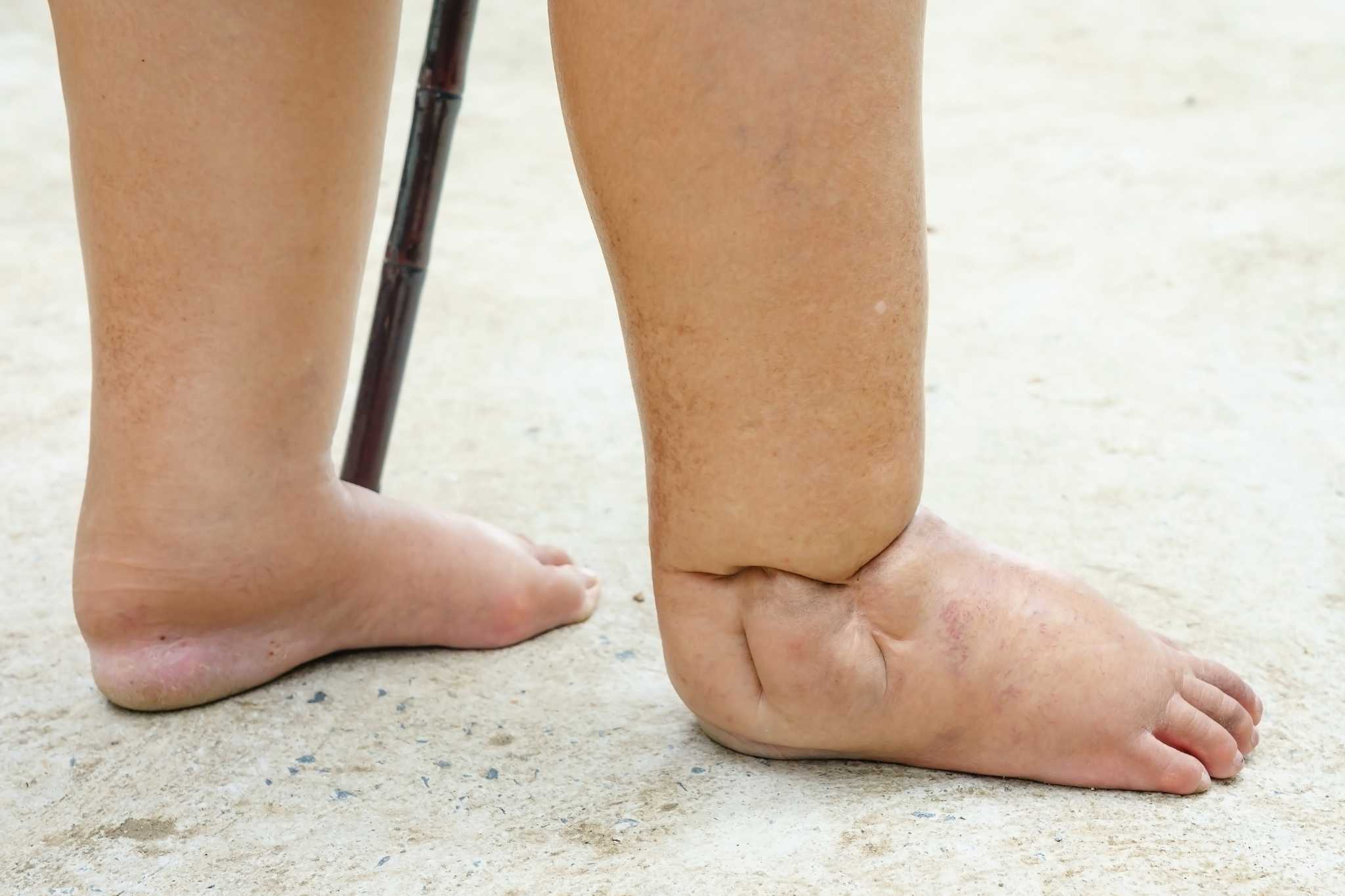 Feet of people with diabetes, dull and swollen. Due to the toxicity of diabetes placed on concrete floor