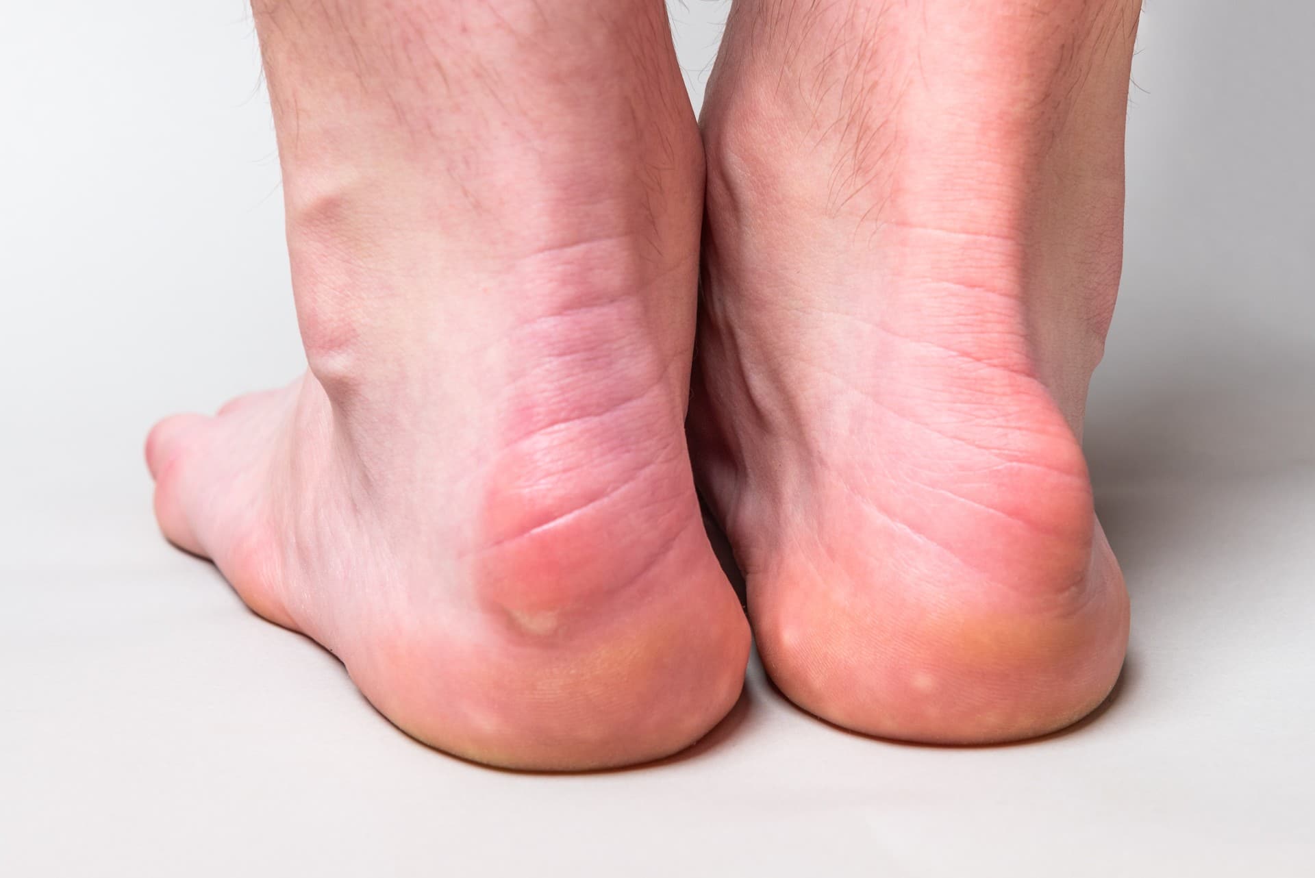 a photo of the back of someone's feet that has Haglund's Deformity