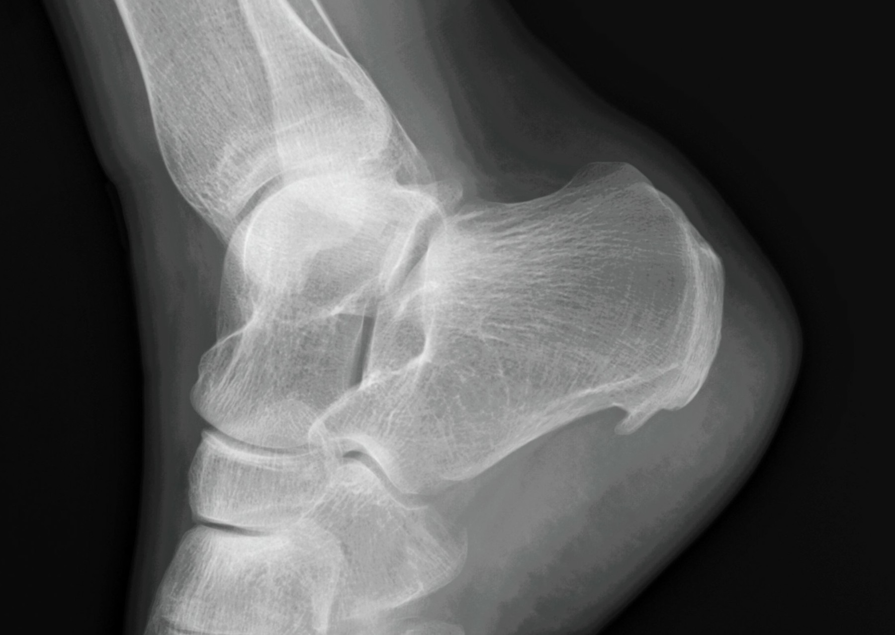 an x-ray showing a heel spur