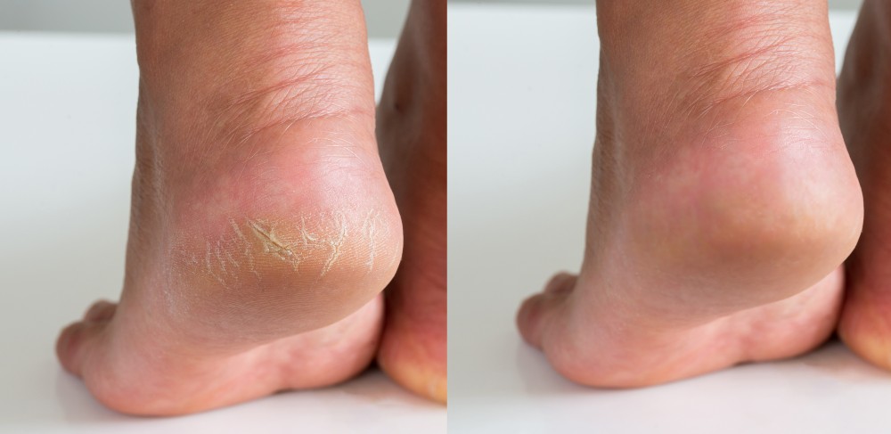Before and after treatment for dry feet or cracked feet