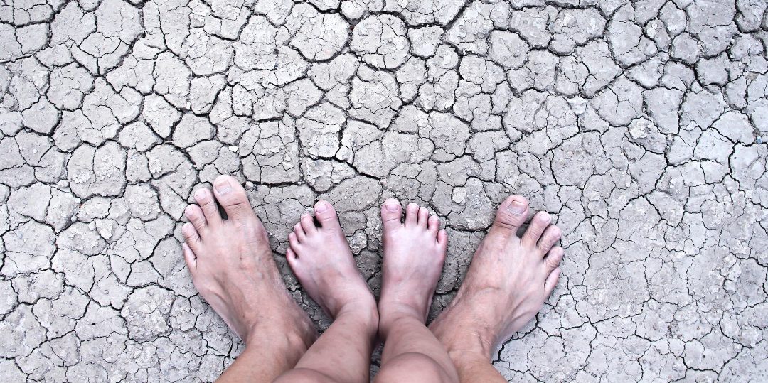 Why Do I have Dry Feet or Cracked Feet?
