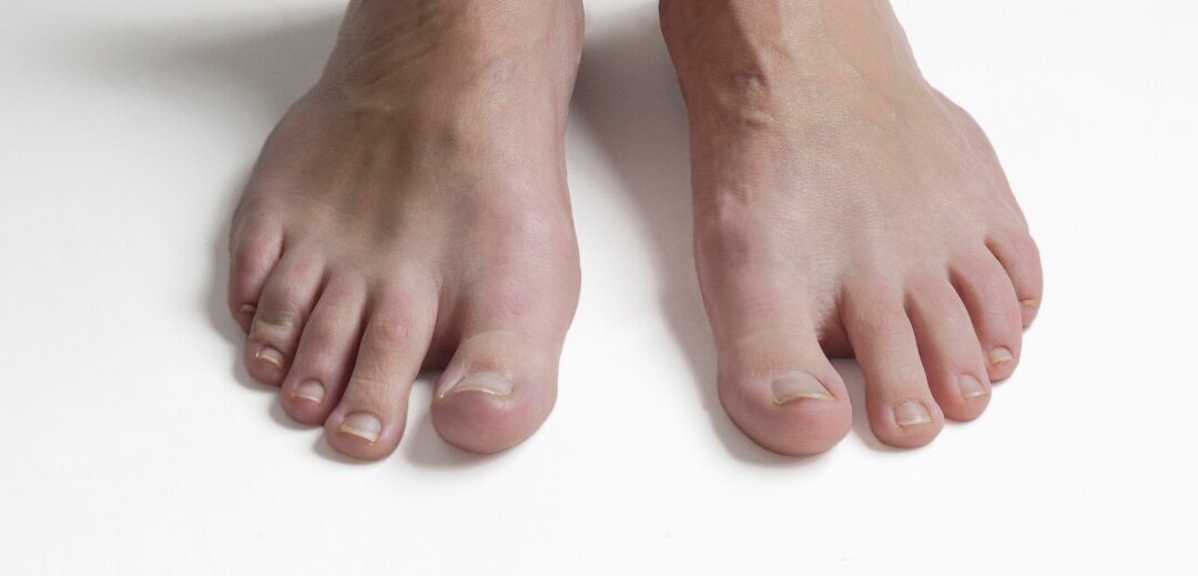What are Your Options for Treating Toenail Fungus?