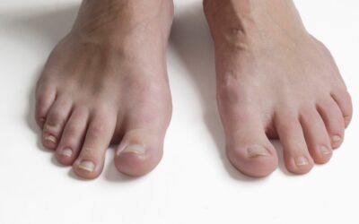 What are Your Options for Treating Toenail Fungus?