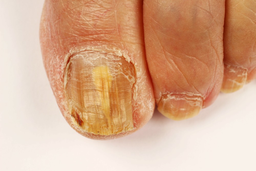 Nails with toenail fungus needing treatment
