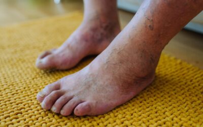 Dangers of Diabetic Feet