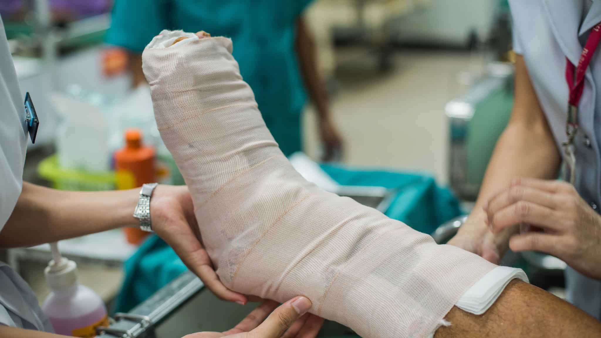 Patient with broken leg and splinted for treatment in the hospital.
