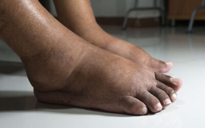 Why Diabetic Foot Care Should Always Start Now
