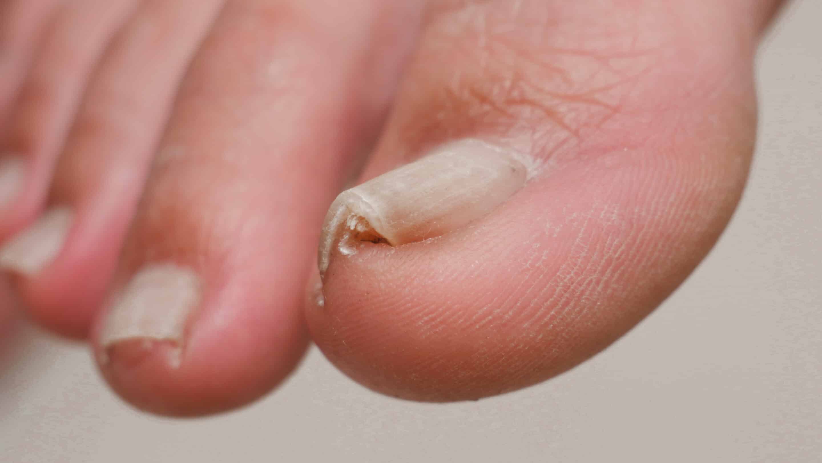 Ingrown toenail