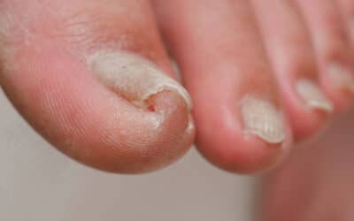 What Should You Do About an Ingrown Toenail?