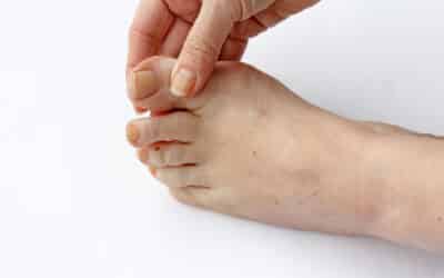Is Toenail Fungus Contagious