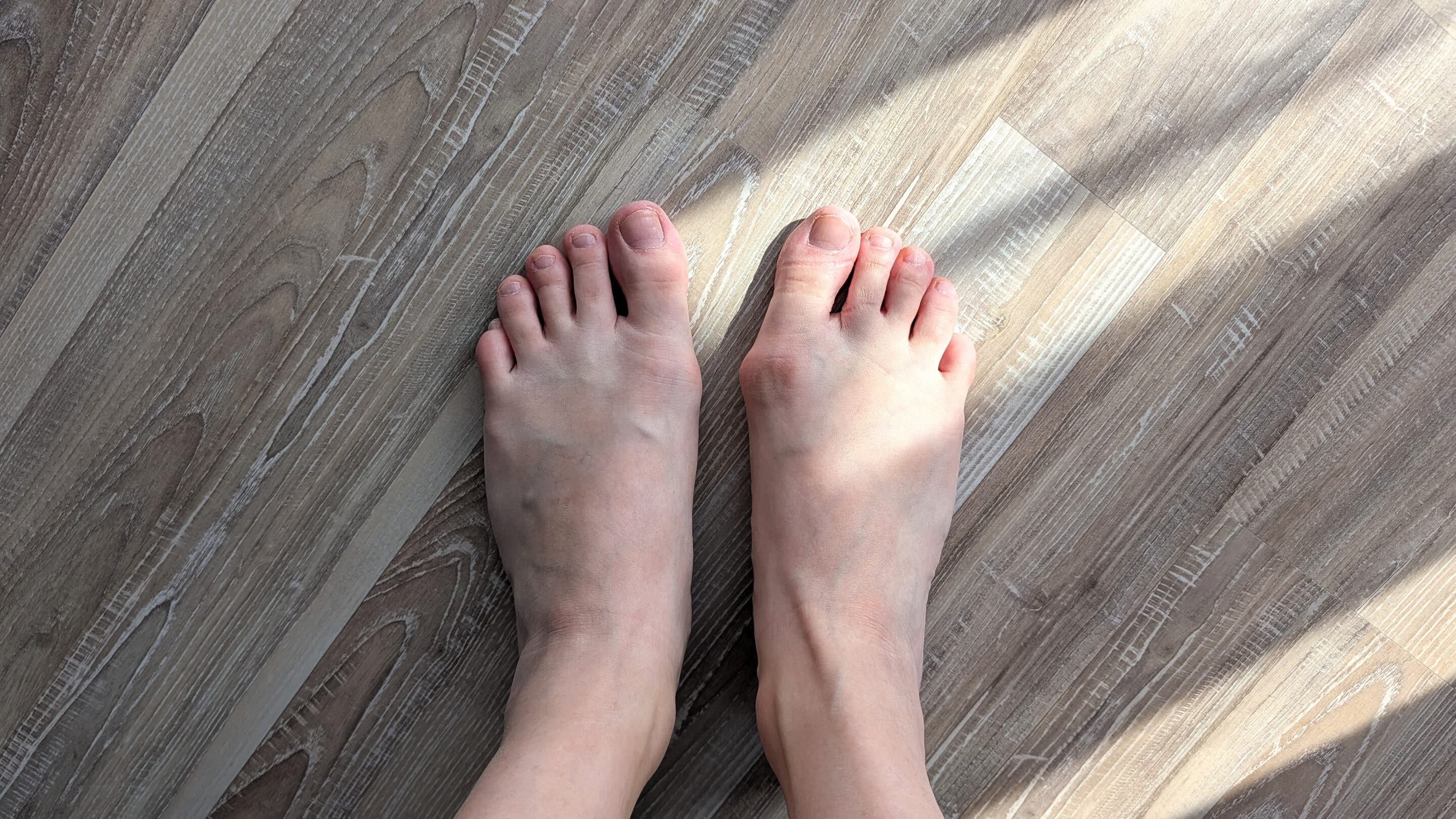 Top Down View of Bare Human Feet on Wooden Floor Showing Hallux Valgus Bunion Deformity on Right Foot Top Down View of Bare Human Feet on Wooden Floor Showing Hallux Valgus Bunion Deformity on Right Foot