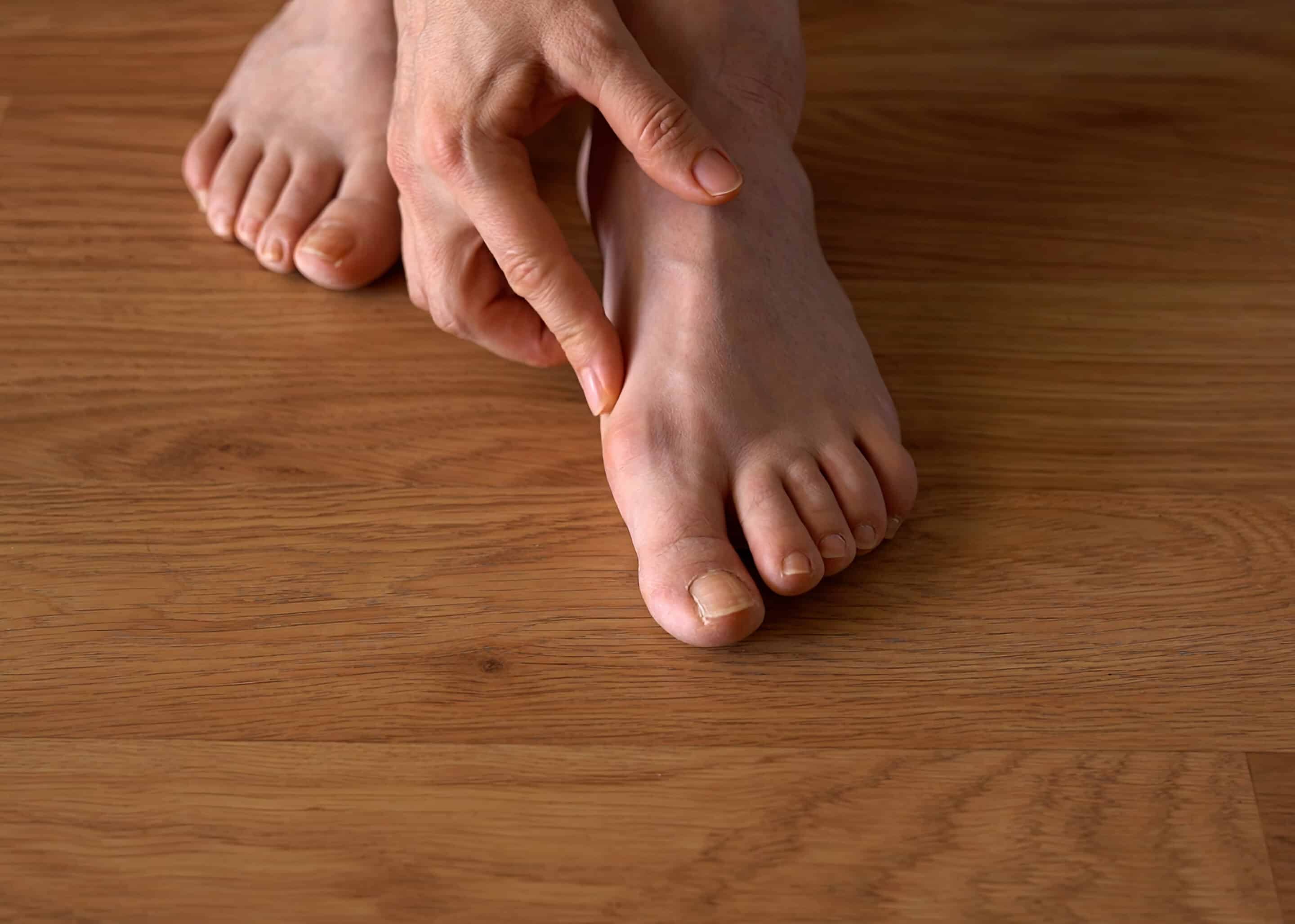 Close-up of a woman s foot with hallux valgus bunion and signs of toenail fungus. Her hand gently touches the deformed big toe, illustrating common foot problems and the need for medical care. Close-up of a woman s foot with hallux valgus bunion and signs of toenail fungus. Her hand gently touches the deformed big toe, illustrating common foot problems and the need for medical care.